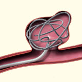 腹腔内血管の動脈瘤に対するコイル塞栓術