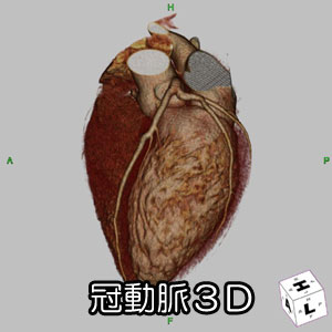 心臓冠動脈３Ｄ撮影