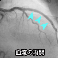 冠動脈造影（ＣＡＧ）および経皮的冠動脈形成術（ＰＣＩ）