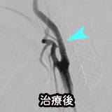 頚動脈狭窄に対するステント挿入術