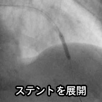 冠動脈造影（ＣＡＧ）および経皮的冠動脈形成術（ＰＣＩ）