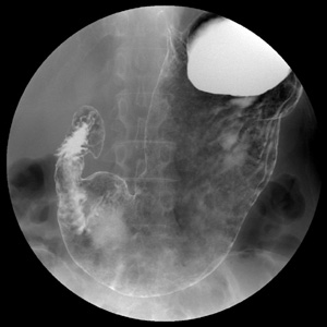 胃十二指腸造影（胃バリウム検査）