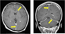 低髄液圧状態のMRI